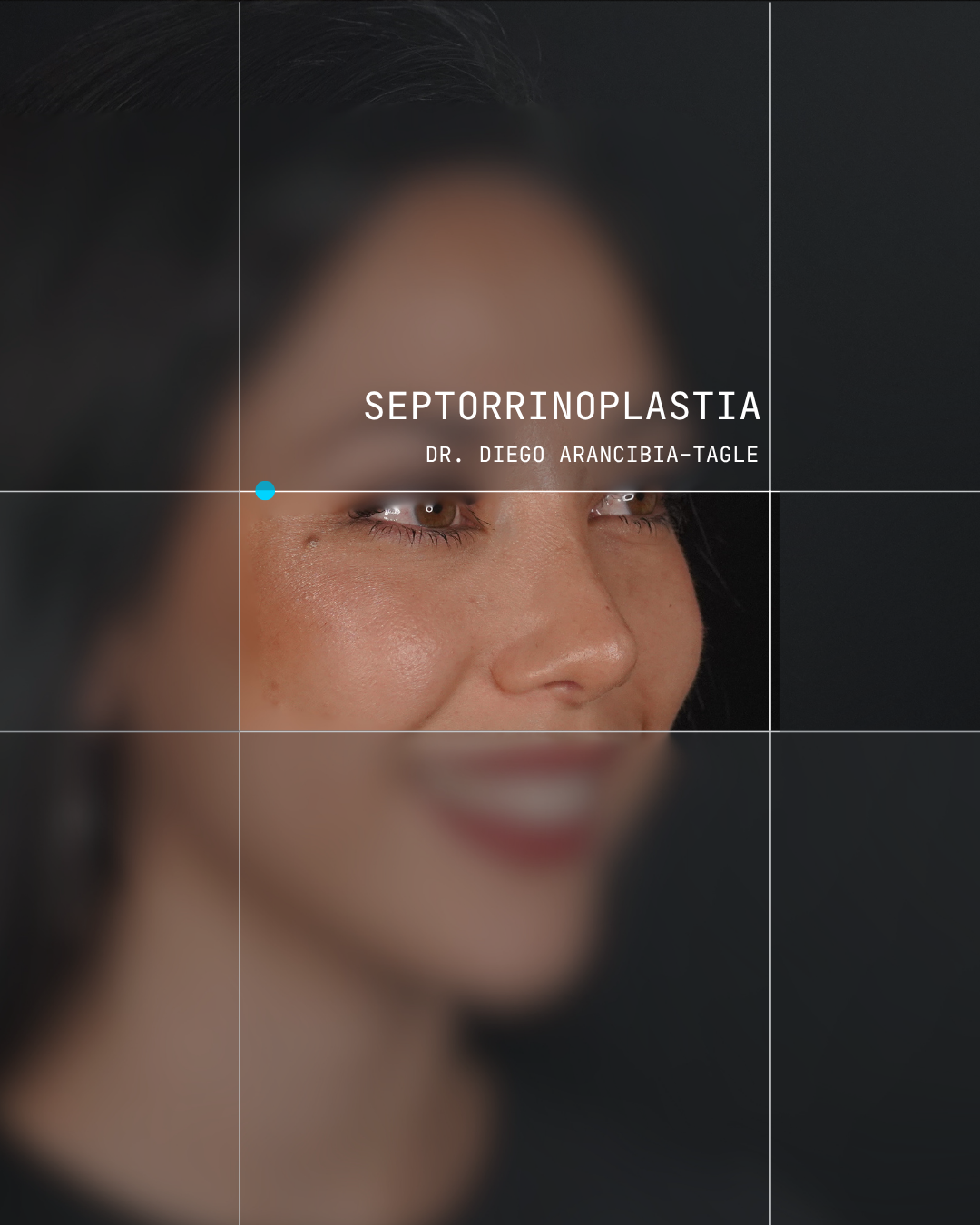 Caso real de rinoplastia 1