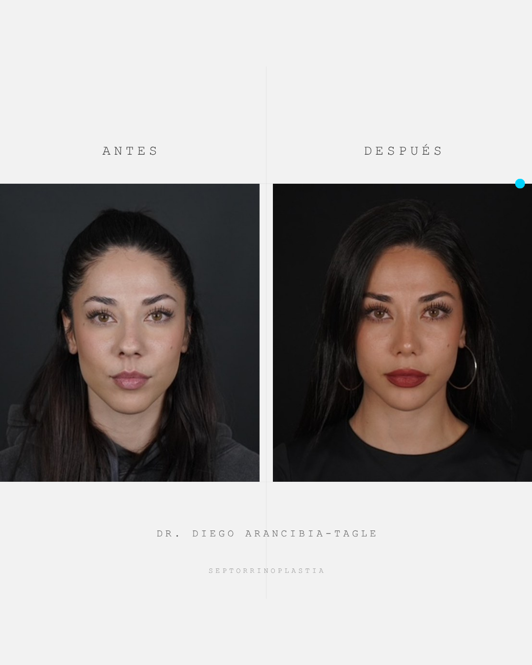 Caso real de rinoplastia 2