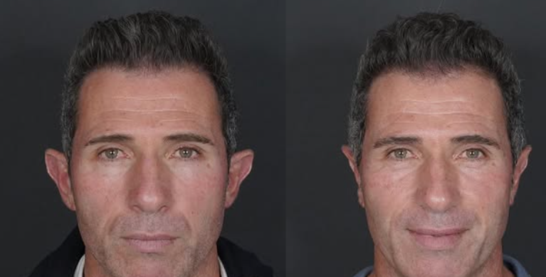 Cada oreja es distinta. La corrección también debe serlo.