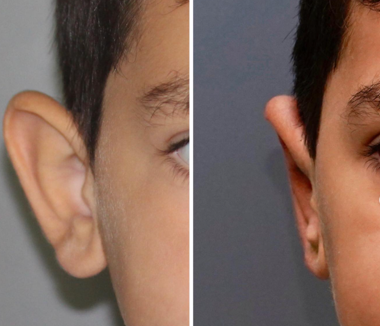 Cada oreja es distinta. La corrección también debe serlo.