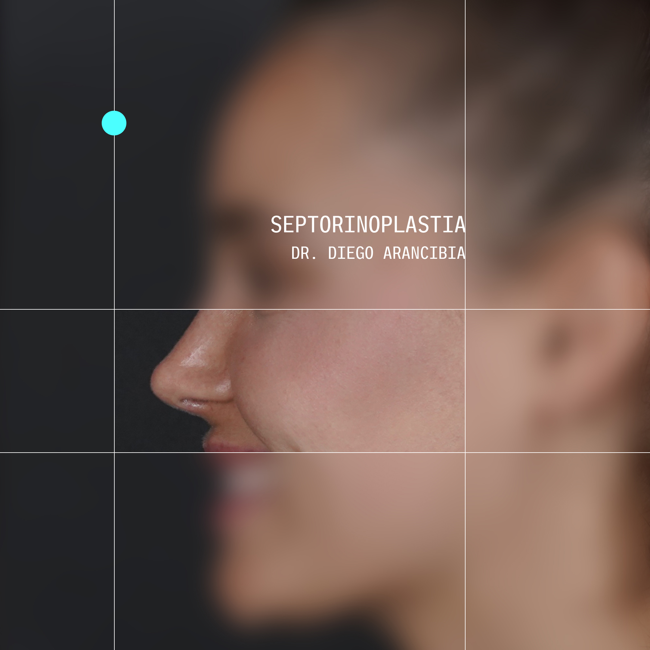 Caso real de rinoplastia 5