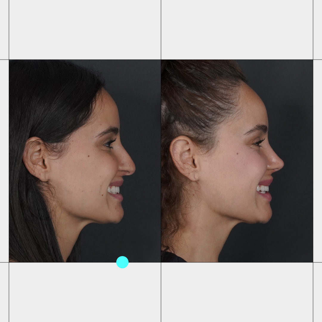 Caso real de rinoplastia 6