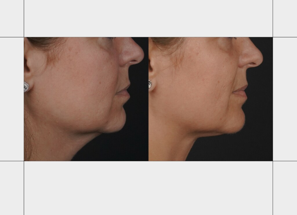 Platismoplastia