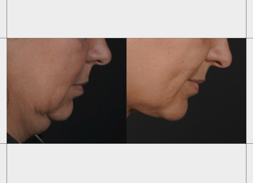 Fotografía autorizada de un caso clínico de lifting facial