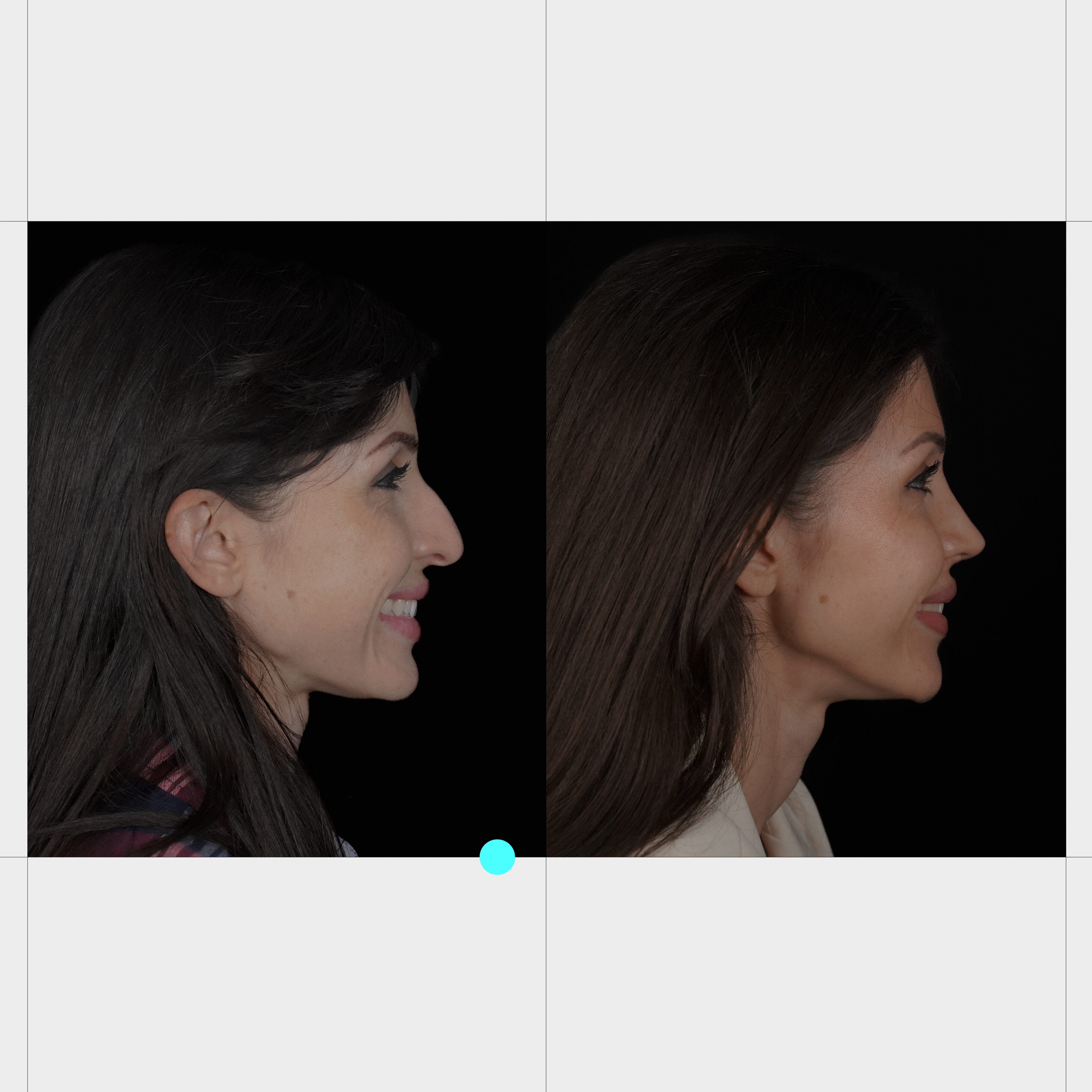 Caso real de rinoplastia 3