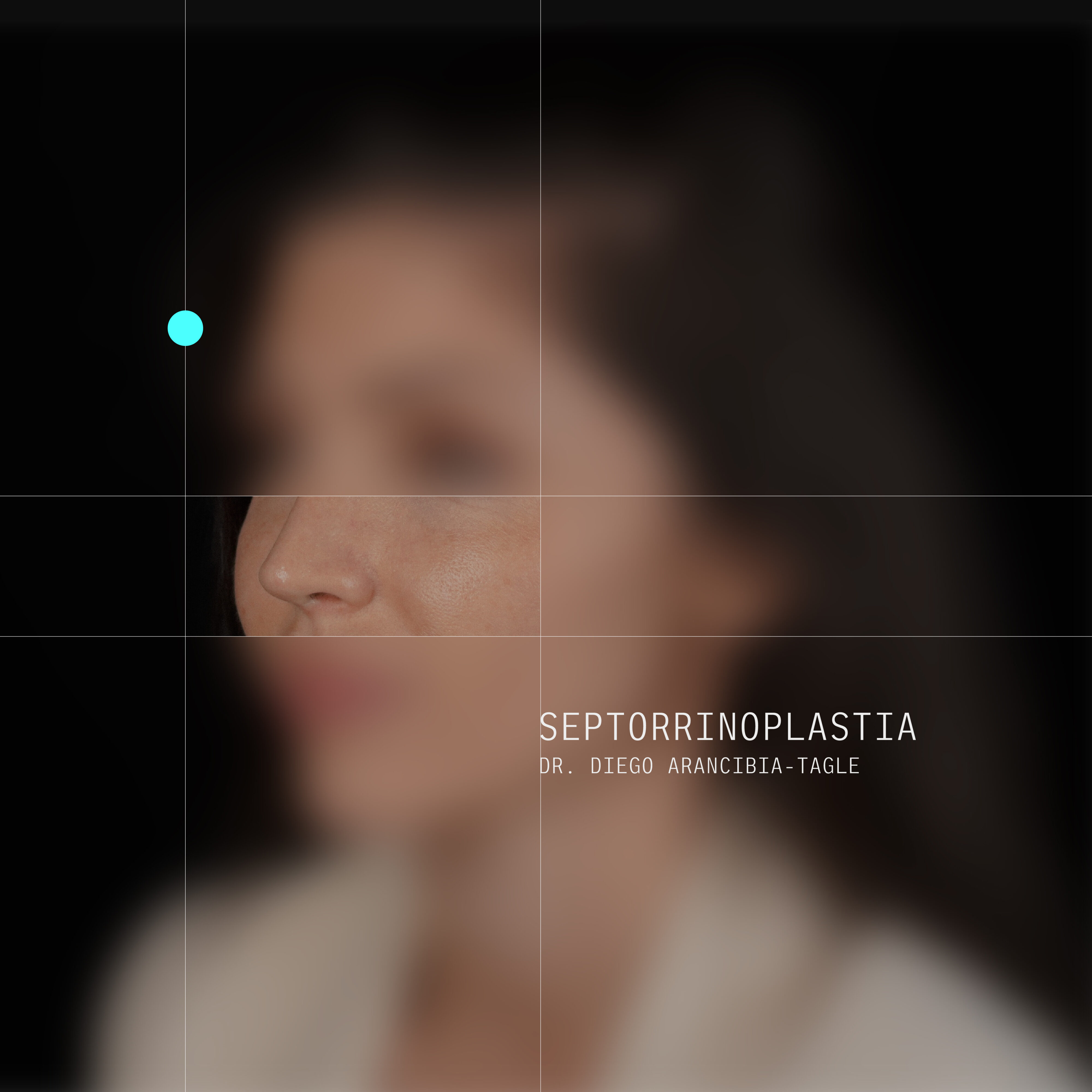 Caso real de rinoplastia 4