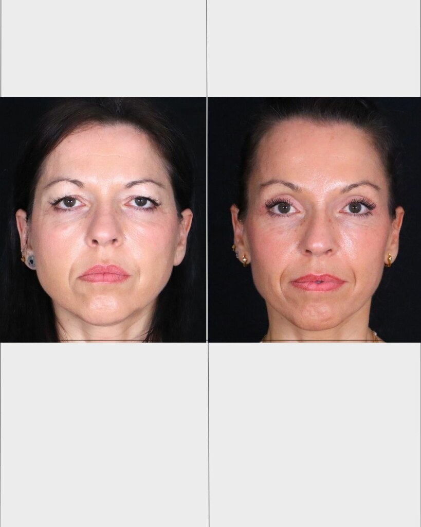 Fotografía autorizada de un caso clínico de lifting facial
