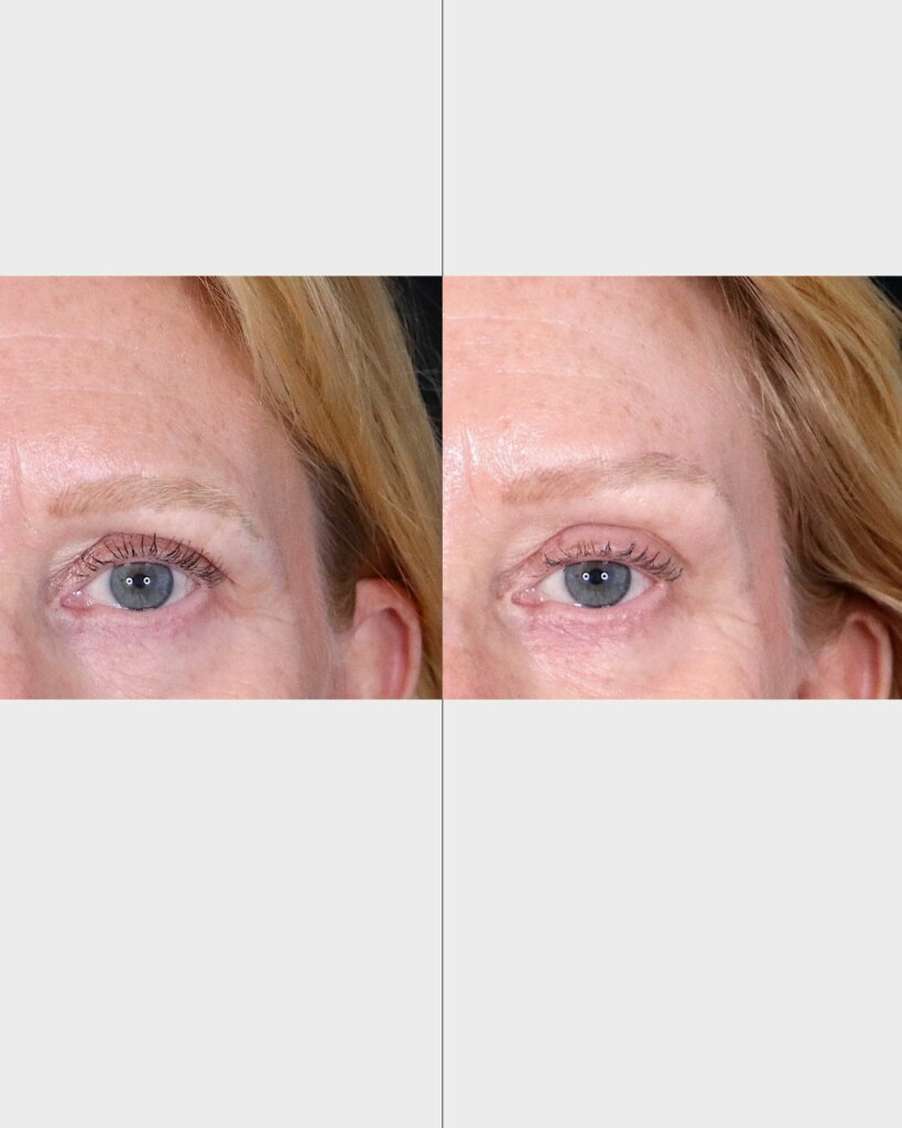 Fotografía autorizada de un caso clínico de lifting facial