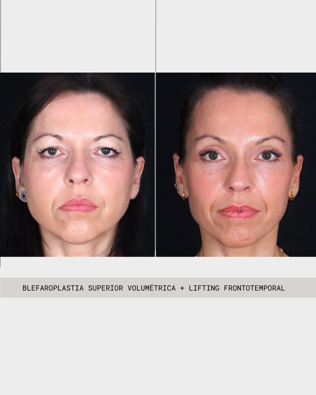 Lifting frontotemporal +Blef Super Vol Caso clínico 5