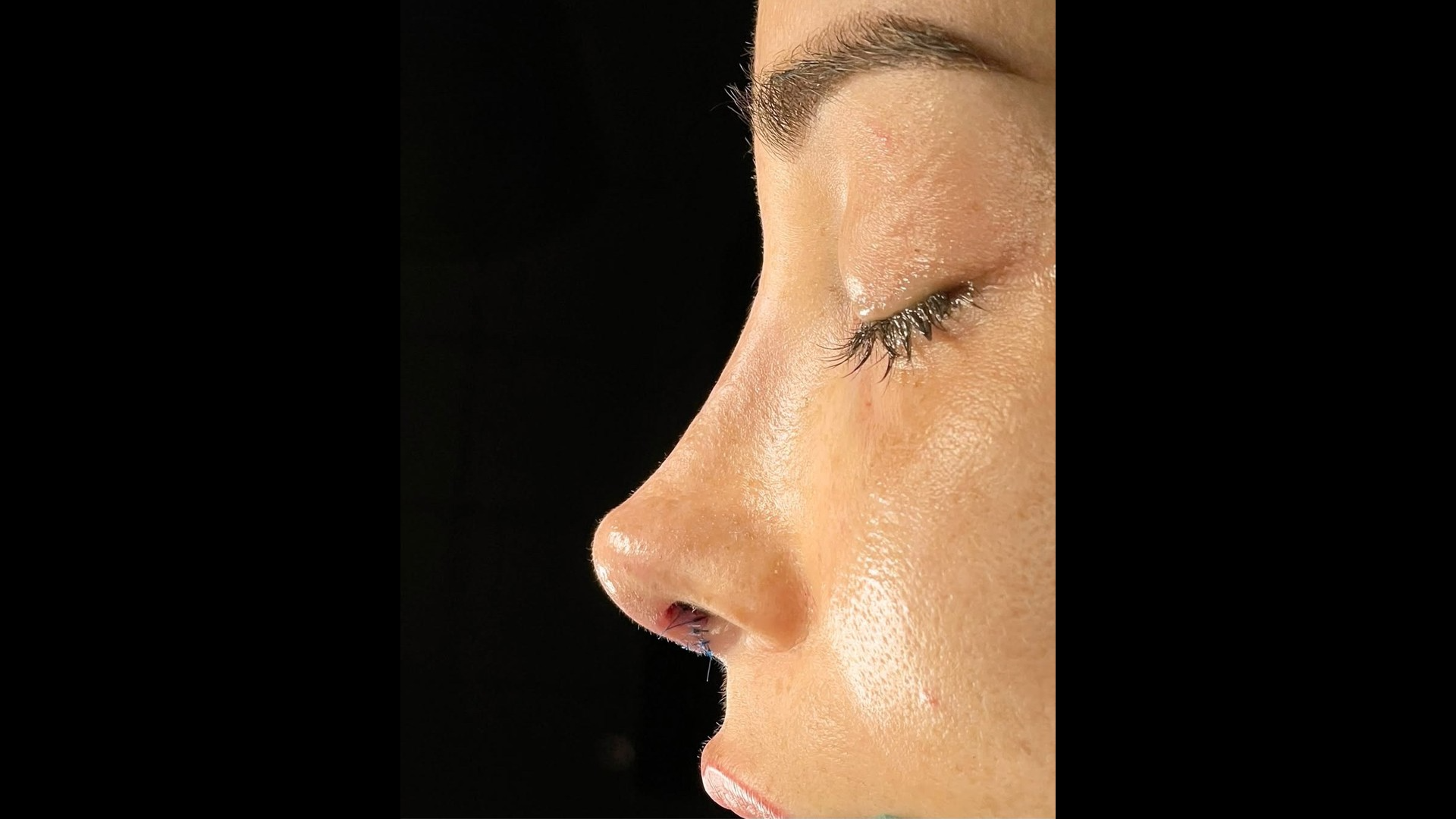 Rinoplastia personalizada en Rhino & Face